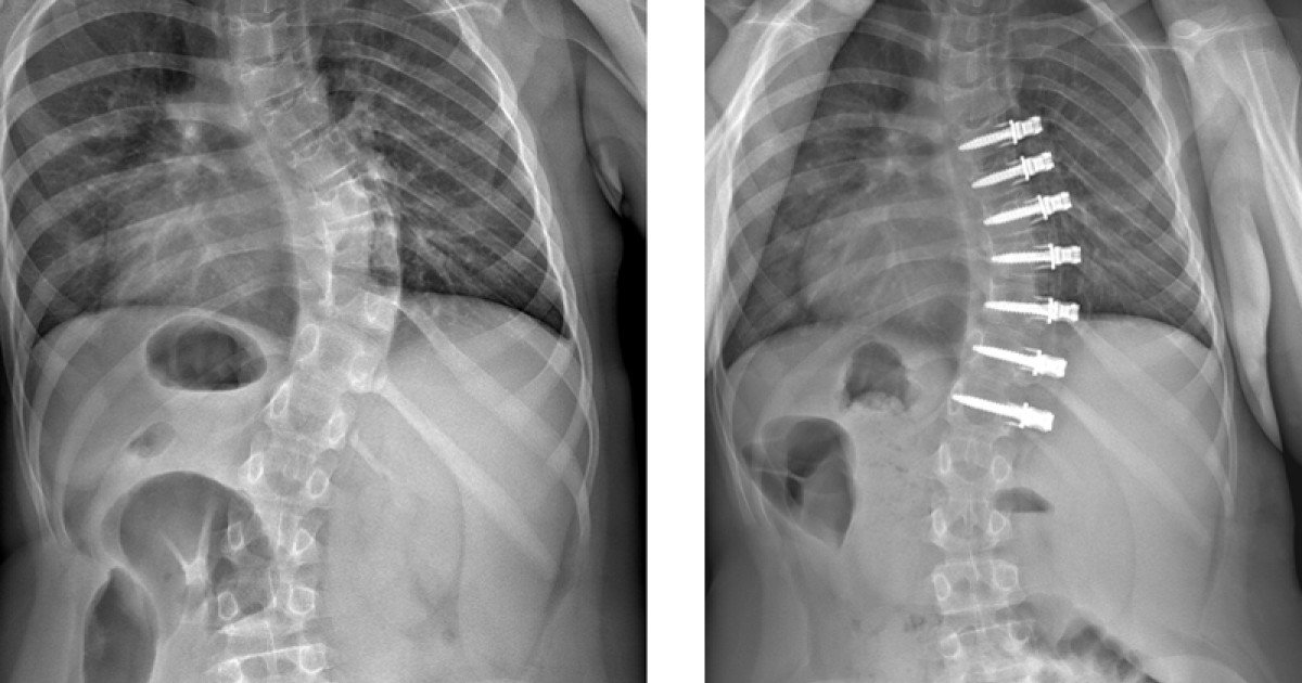 Bewegungserhaltende Skoliose Operation Schulthess Klinik